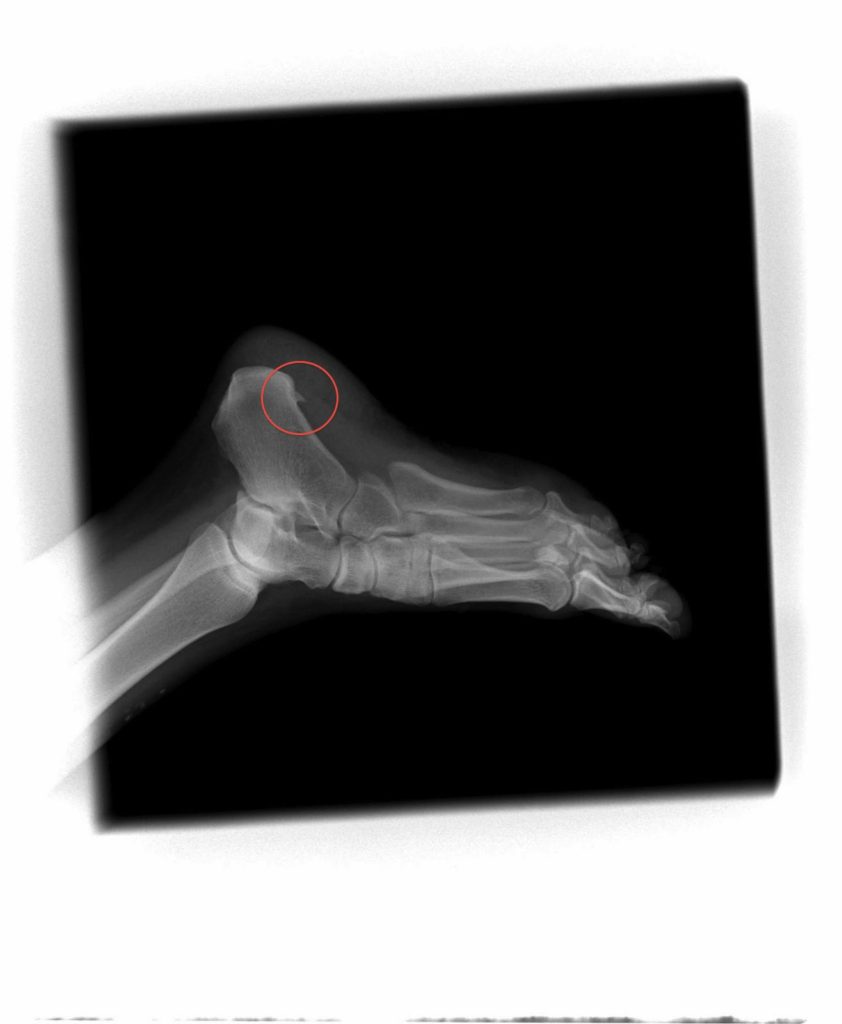 Heel Spur. No Kidding.